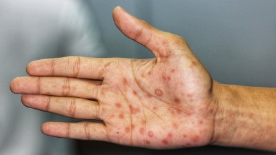 Qué es la sífilis y cómo te puede afectar