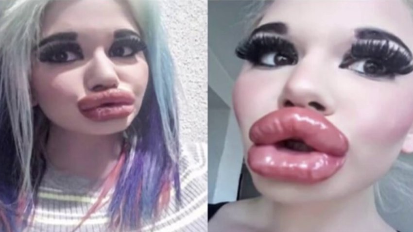 La “barbie humana”: mujer se opera para tener los labios más grandes del mundo