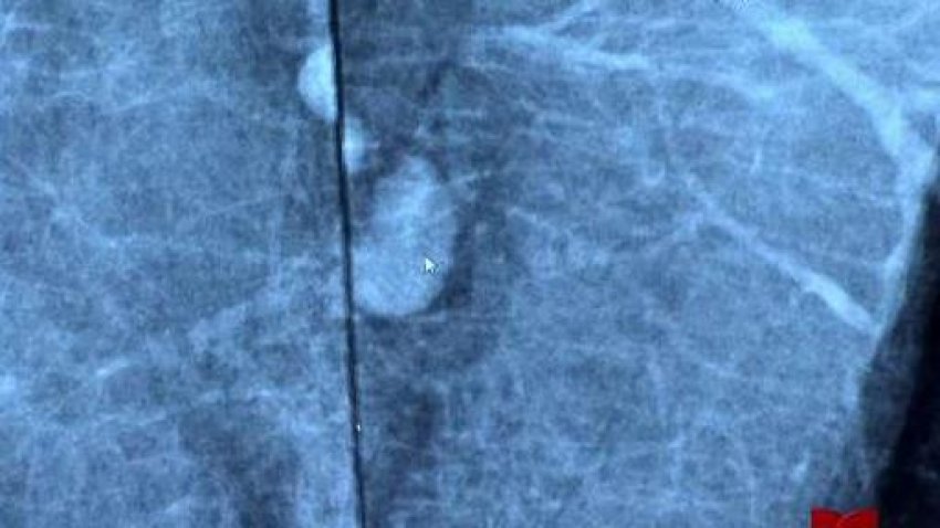 Inflamación de ganglios en las axilas