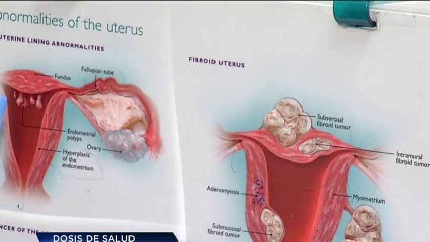 Cirugía mínimamente invasiva permite la remoción de pólipos y fibromas