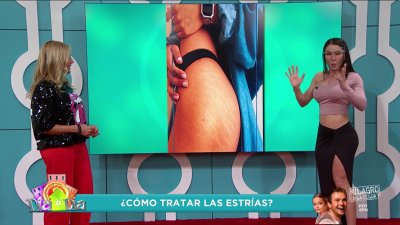 ¿Cómo tratar las estrías?
