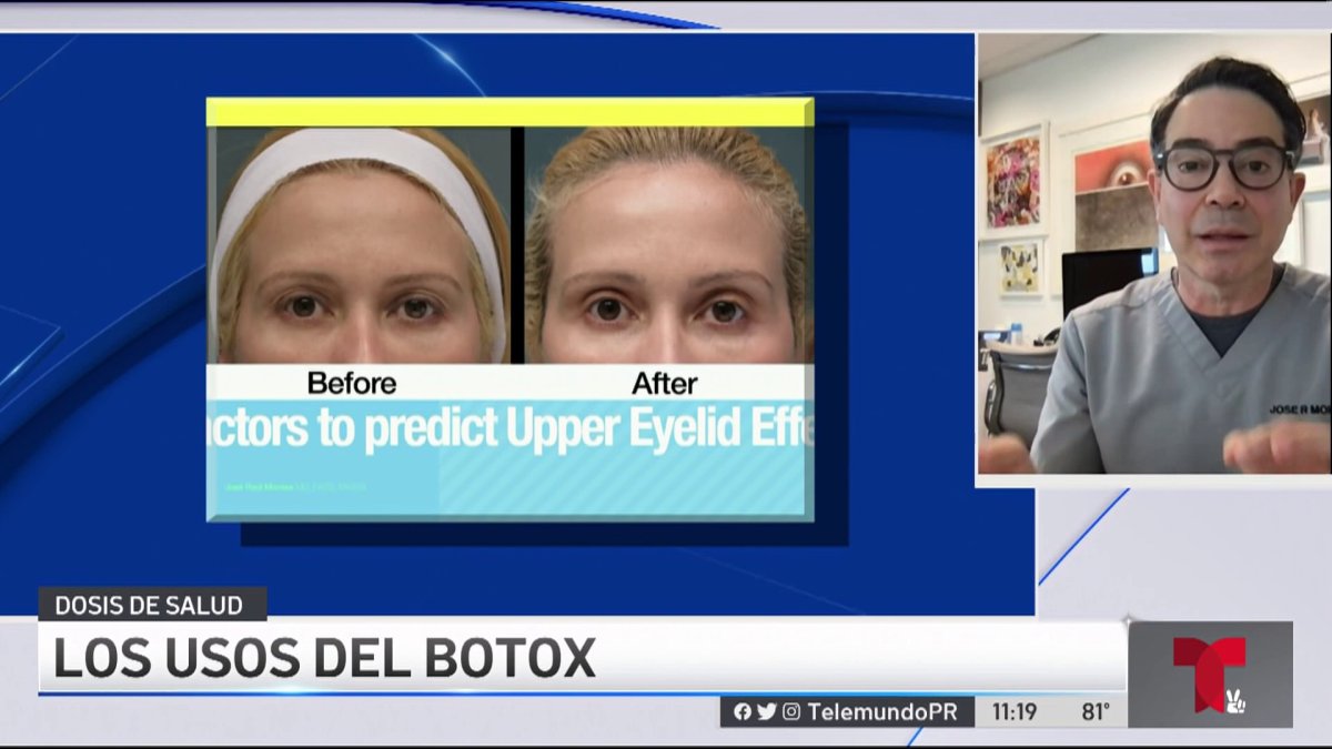 Más allá de lo cosmético el botox y sus usos Telemundo Puerto Rico