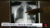 Cáncer de pulmón es el más diagnosticado en hombres puertorriqueños