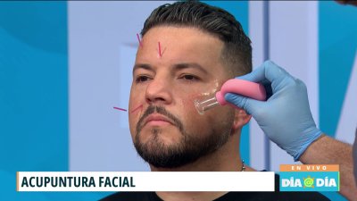 Acupuntura facial: esto es lo que debes saber