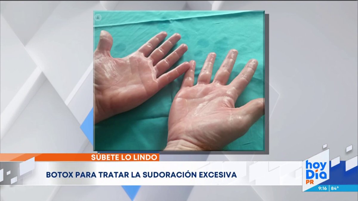 Botox para tratar la sudoración excesiva Telemundo Puerto Rico