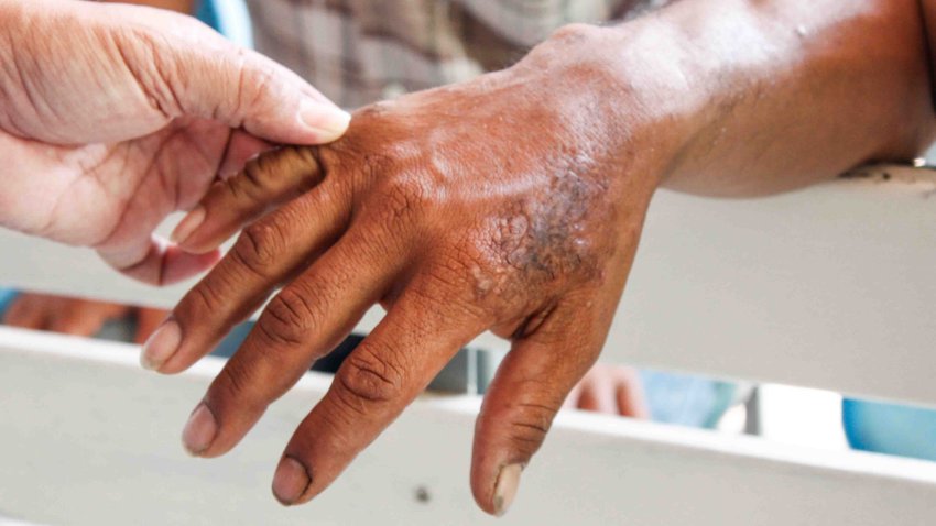 Wound on the skin heals, crusts. Human body with dermatitis. Atopic Dermatitis, allergic to chemicals,Skin ailment or disease closeup,hand skin desease,blurred.