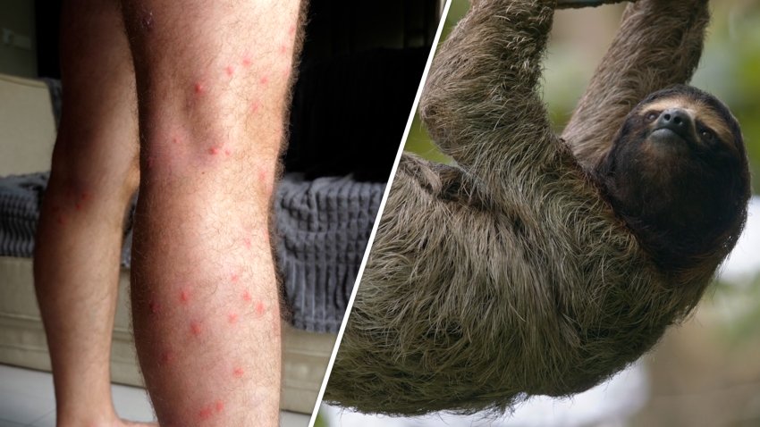 Split screen with man's legs covered in bug bites on left and sloth on right