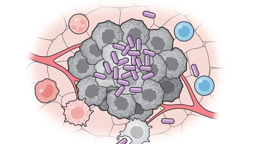 Células bacterianas artificiales (púrpura) activan varias partes del sistema inmunitario para atacar a las células tumorales (gris). Crédito: Universidad de Columbia