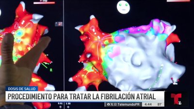 Nuevo procedimiento para tratar la fibrilación atrial