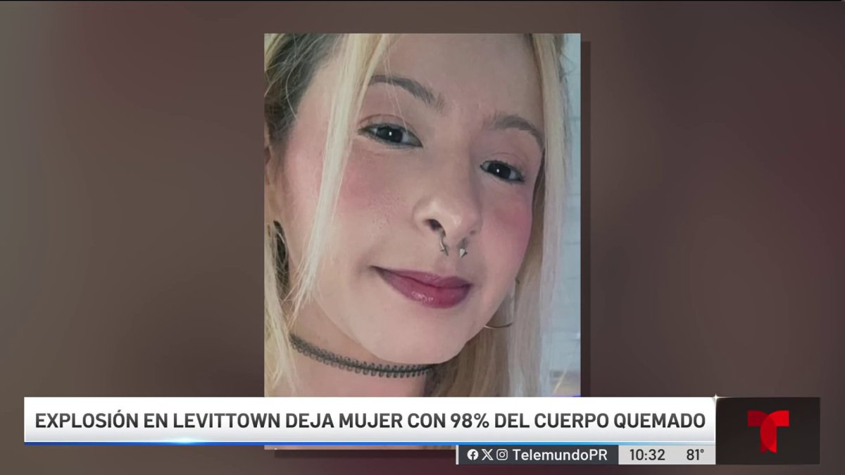 Lucha por sobrevivir mujer con quemaduras en gran parte de su cuerpo ...