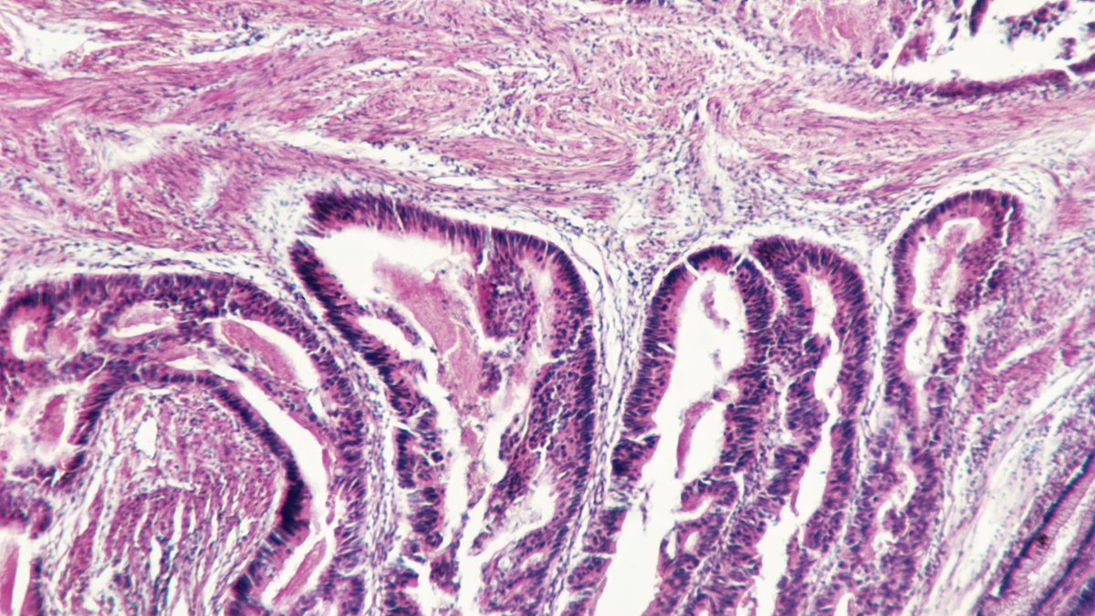 Muertes por cáncer rectal aumentan entre la generación "millennial"