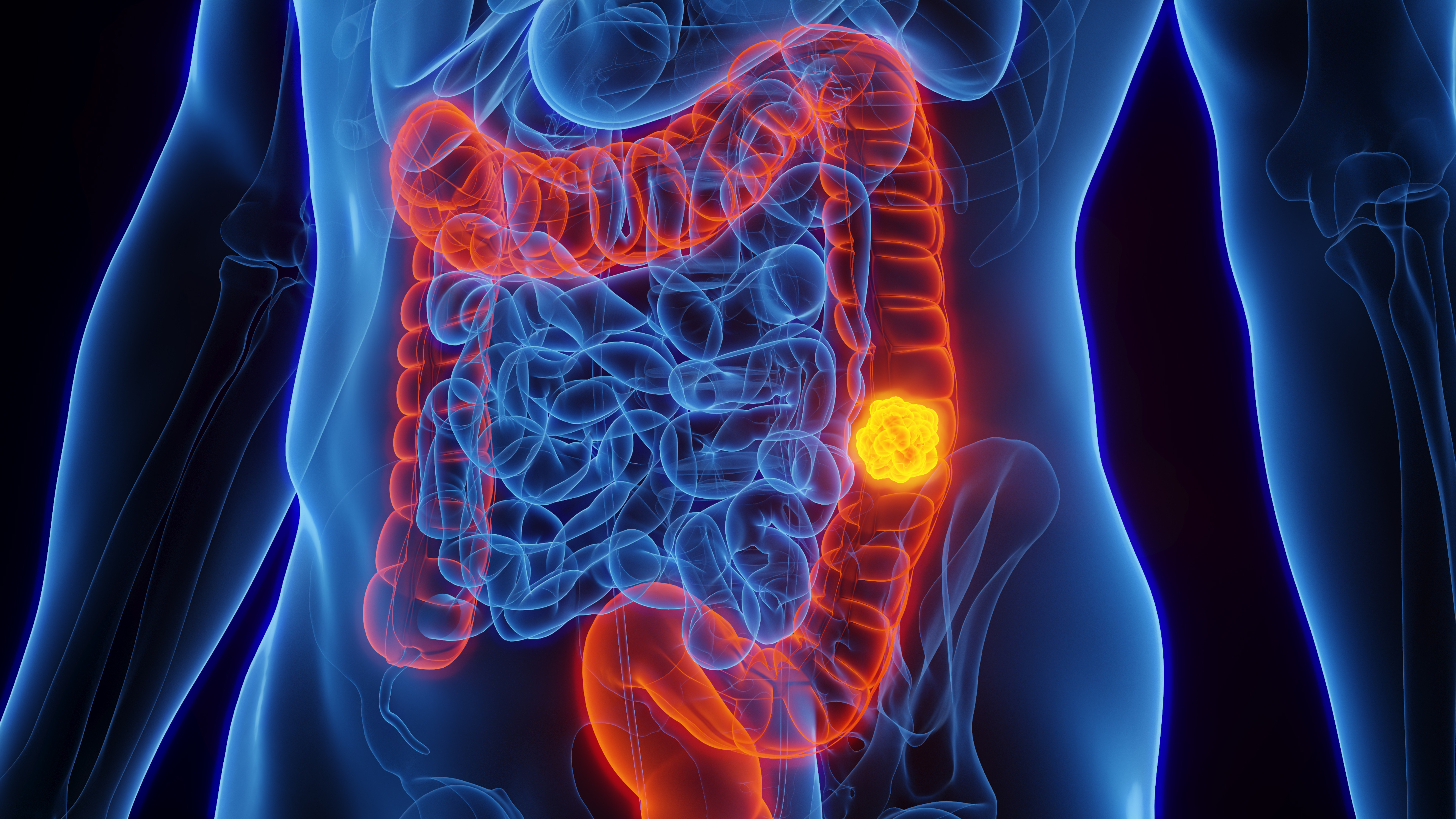 Incluyen un examen de sangre entre opciones para detectar el cáncer colorrectal